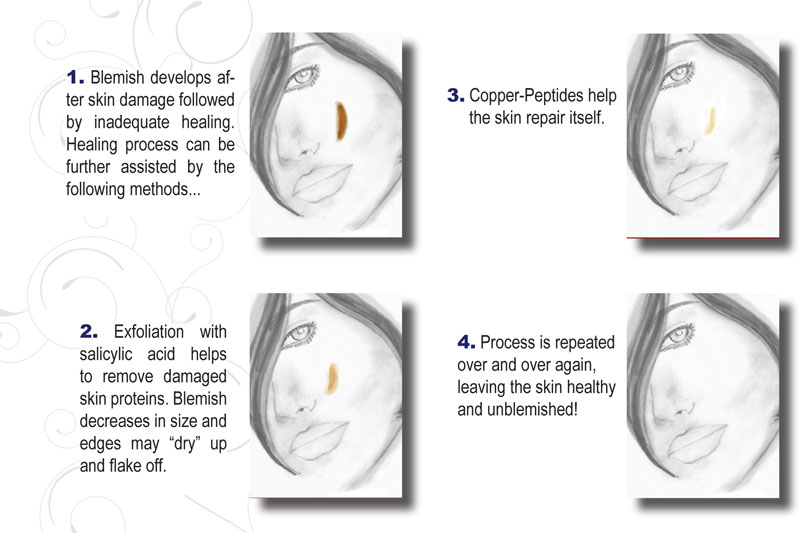 scar remodeling process